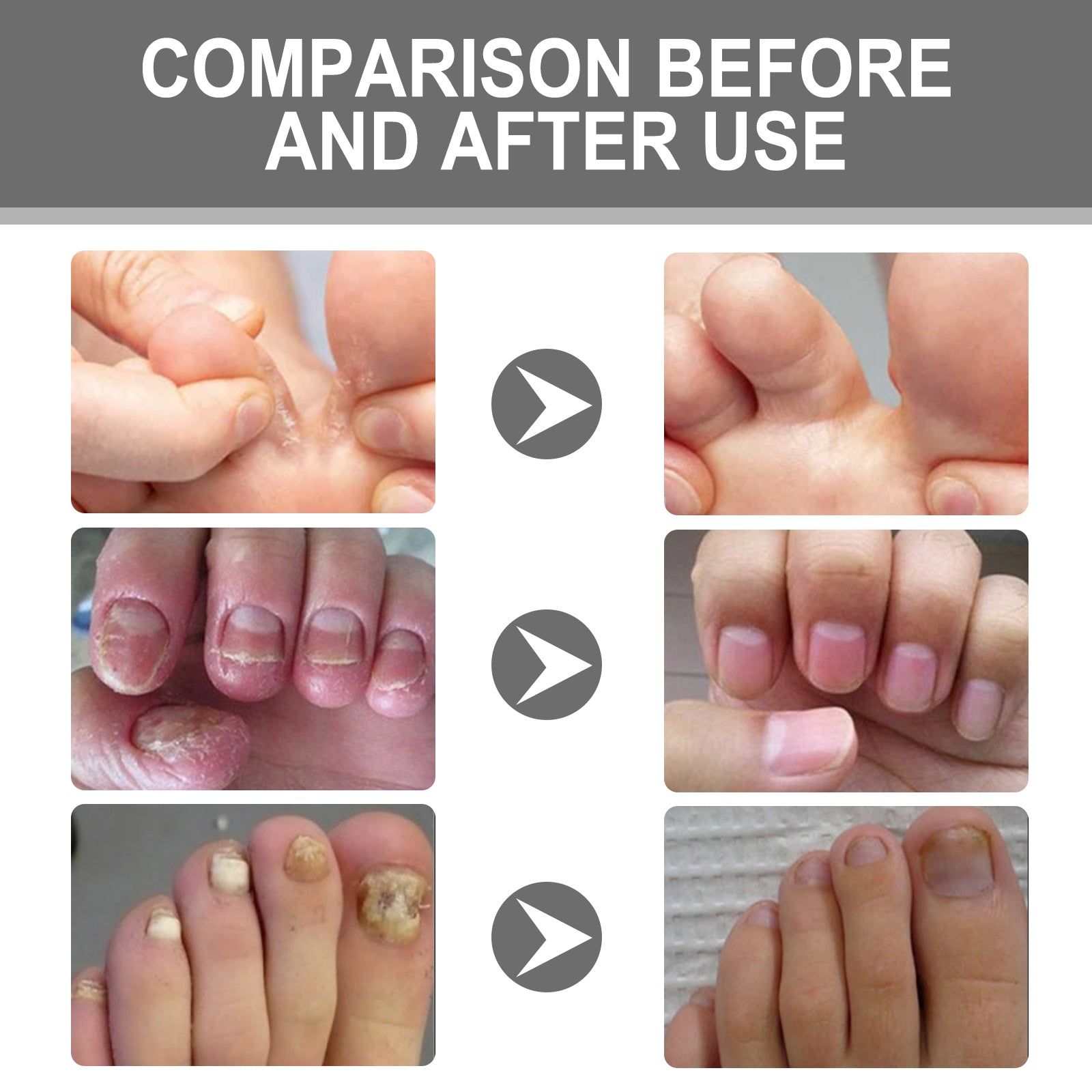 Nail Care Cream, Light Armor Repair Bad Ingrown Nail Nails Brothers Nail Thickening A Ditch Nursing