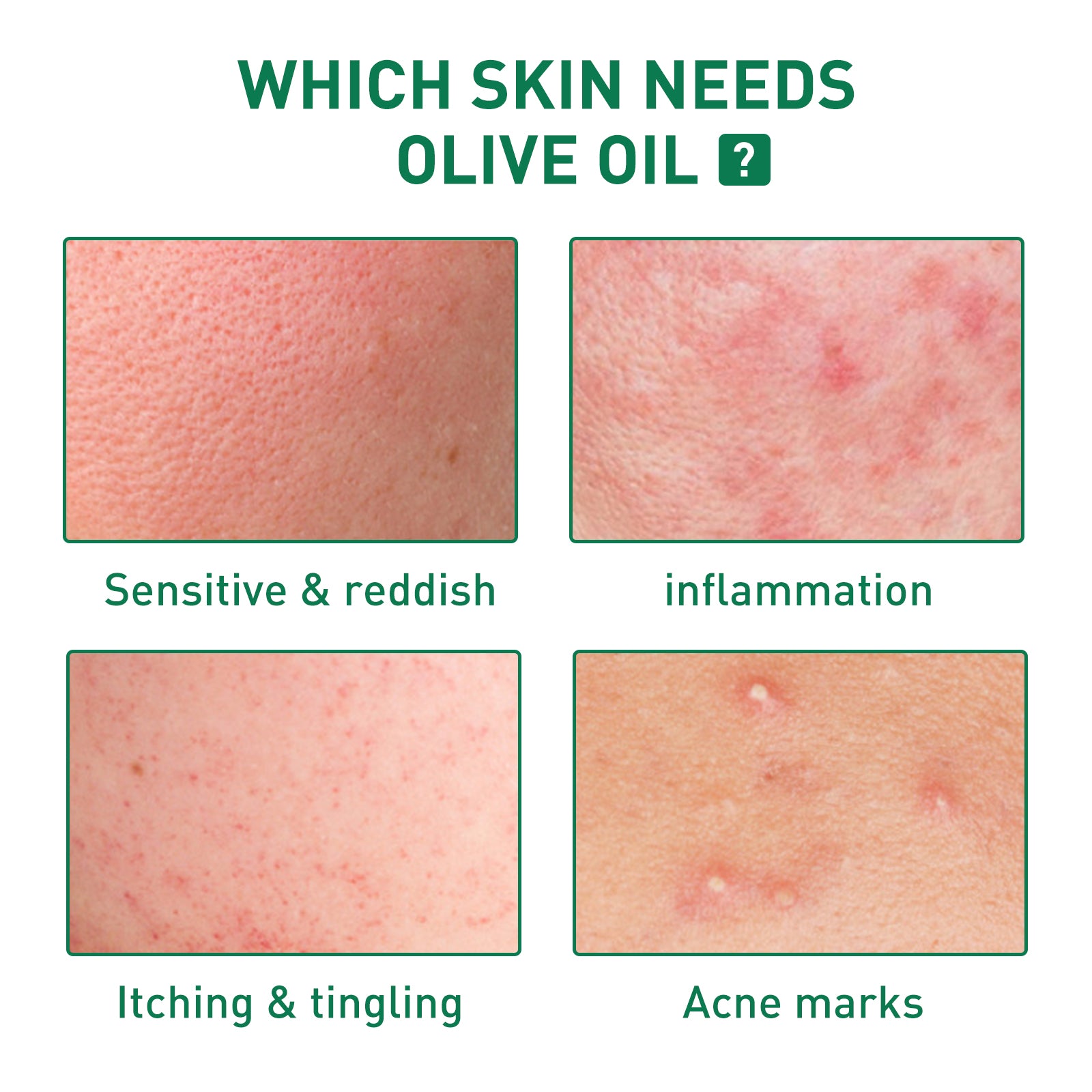 Tea Tree Oil Acne Serum, Remove Acne, Clear Acne, Repair Skin, Lighten Acne Printing Face Essence