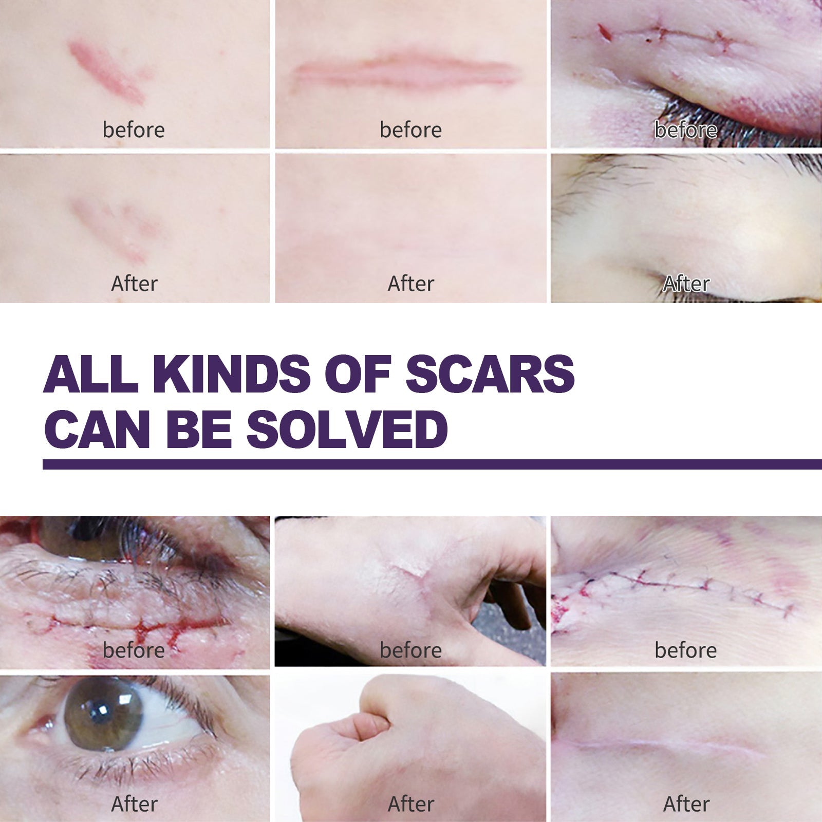 Silicone Scar Patch, Reduces Stretch Marks And Hyperplasia Of Caesarean Section Scars Silicone Patch