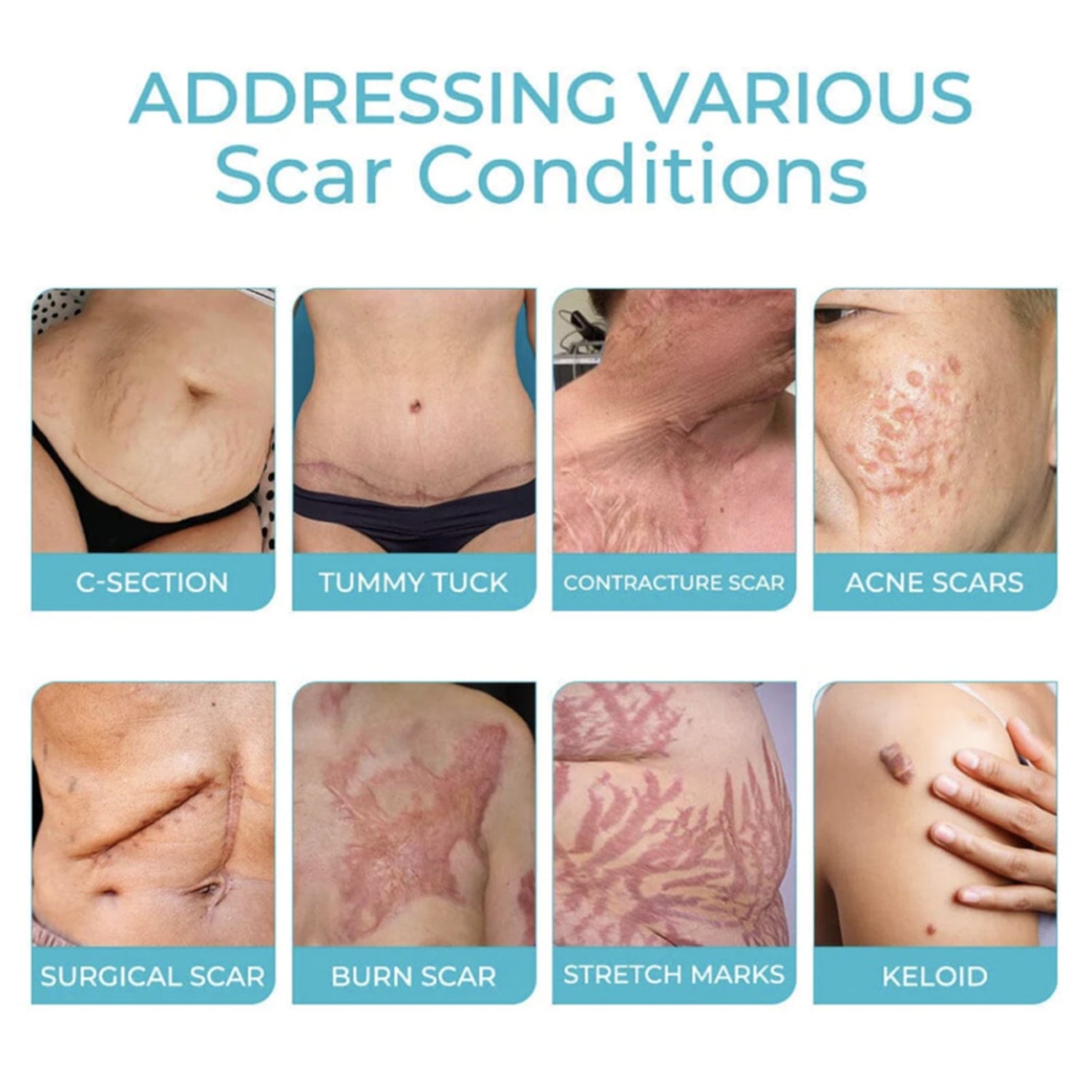 Scarfree Advanced Skin Spray, Body Skin Care Reduces Post-Natal Scars And Smooths Skin