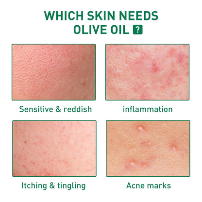 Tea Tree Oil Acne Serum, Remove Acne, Clear Acne, Repair Skin, Lighten Acne Printing Face Essence