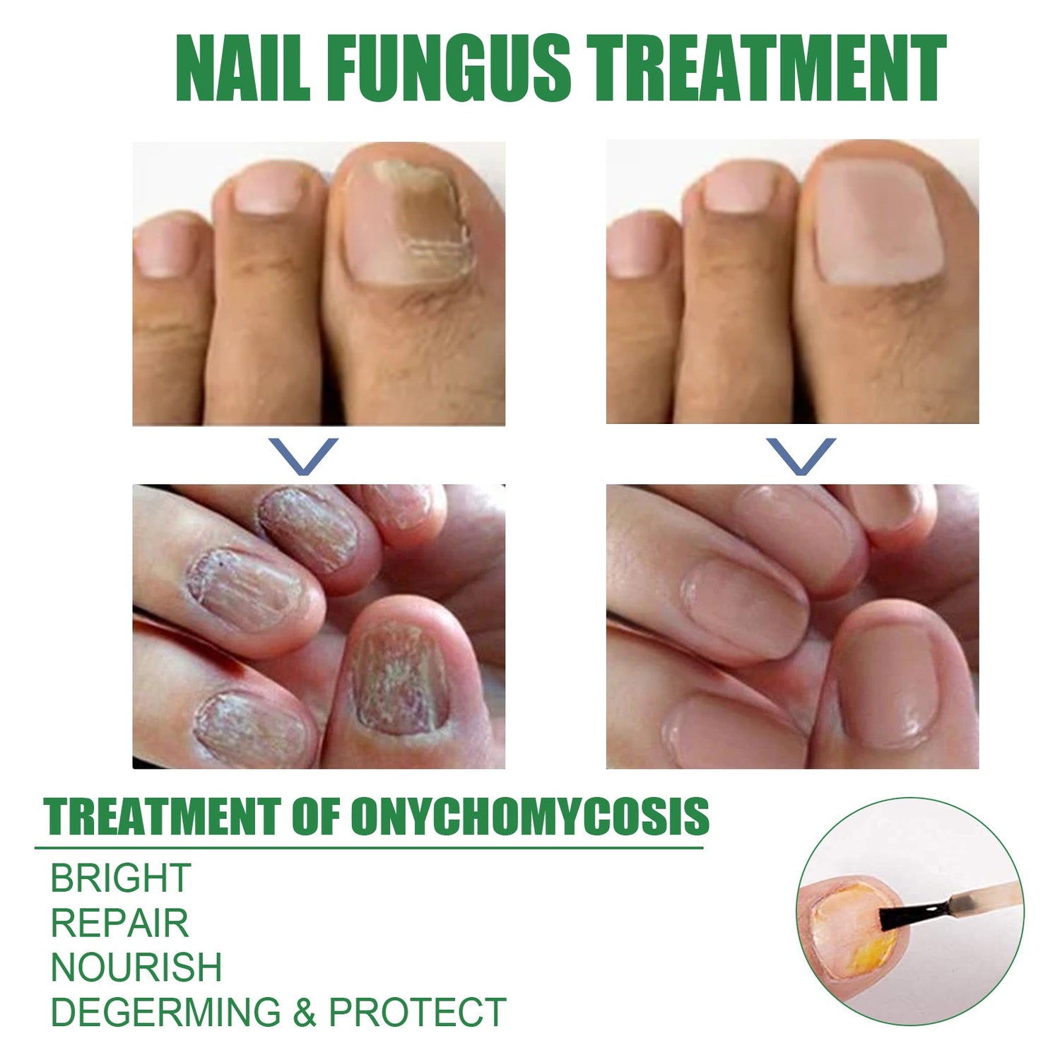 Nail Repair Solution Tea Tree Oil Essence Gentle Nourishing Manicure Cleansing Soft Nail Care Solution