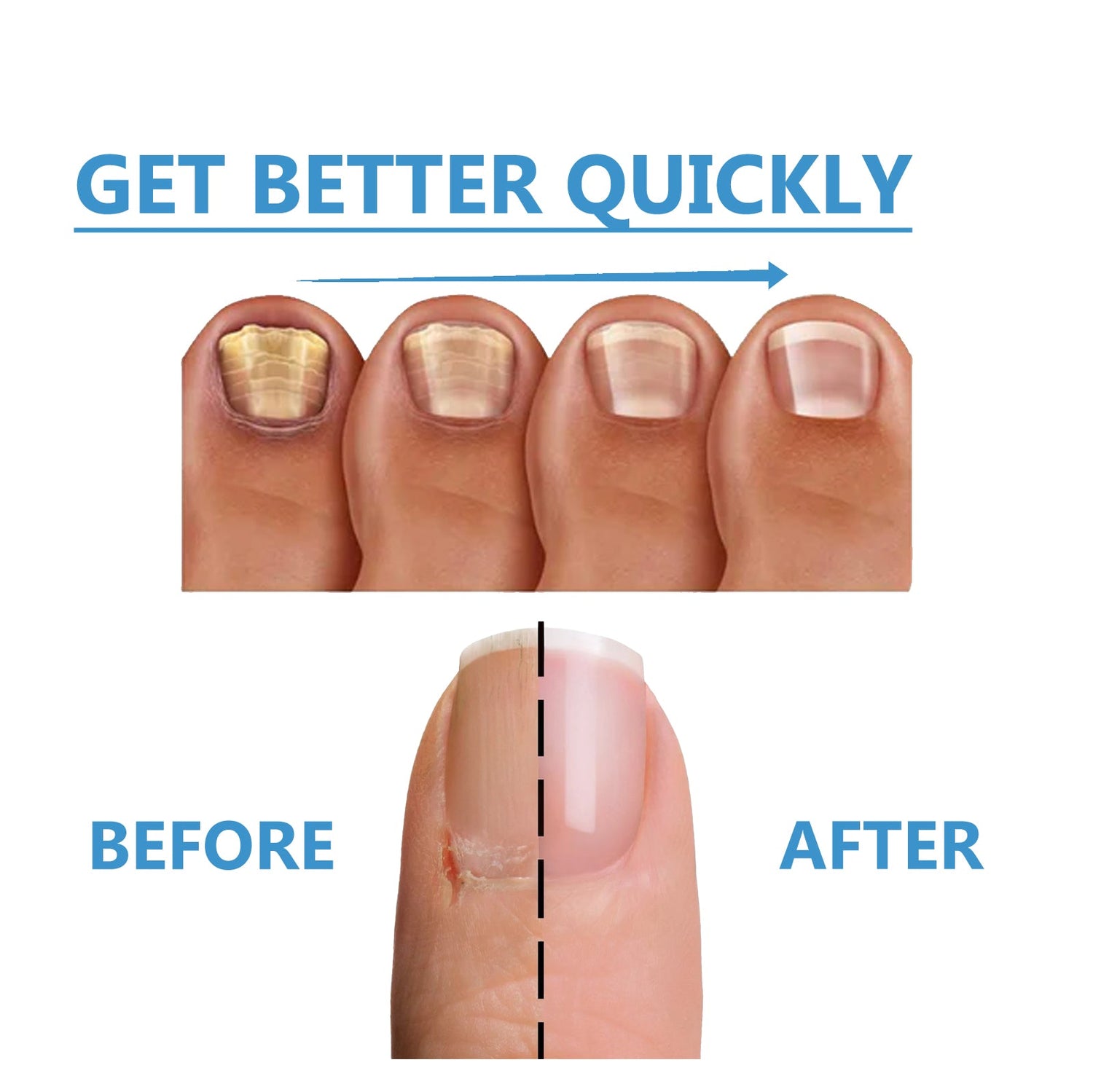 Nighttime Fungal Nail Treatment Patch, Repair Hand And Foot Inlay Rotten Nails Thickening Gray Nail Polish Care Patch