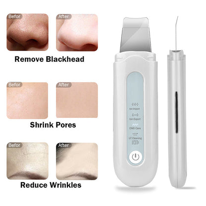 Ultrasonic Pore &amp; Blackhead Cleaner