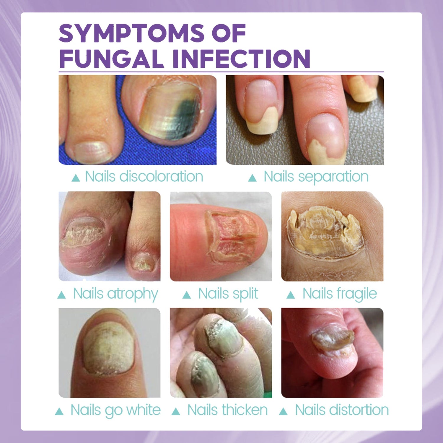 Gray Nail Care Spray Soft Ingrown Nails, Ingrown Nails, Yellowing And Thickening Cleaning Care