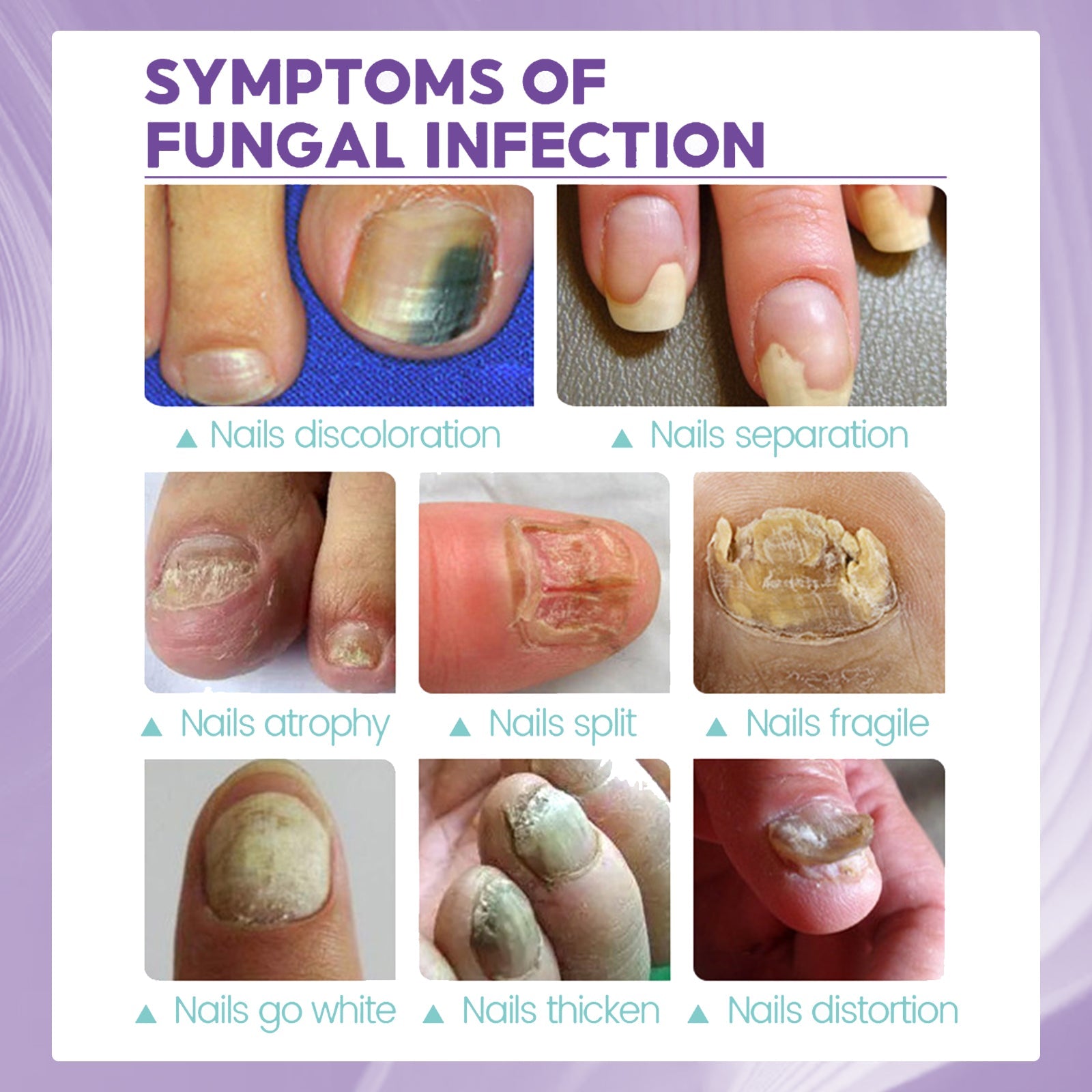 Gray Nail Care Spray Soft Ingrown Nails, Ingrown Nails, Yellowing And Thickening Cleaning Care