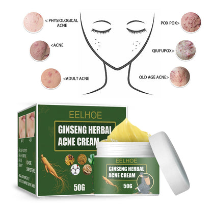 Herbal Acne-Removing Cream Anti-acne-Removing Cream Moisturizing Cleansing Cream Water Oil Balance Anti-acne-Removing Cream