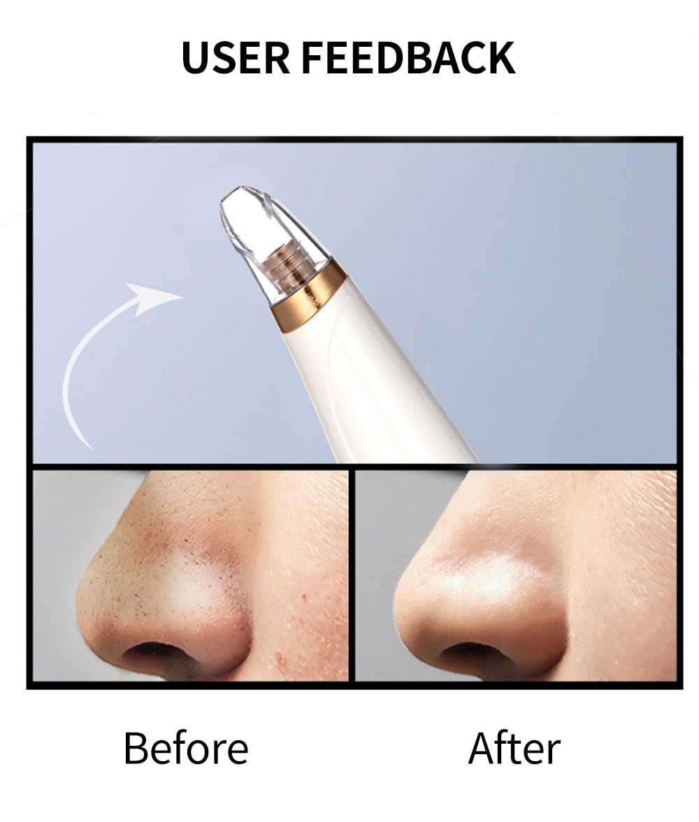 Diamond Blackhead Vacuum Remover