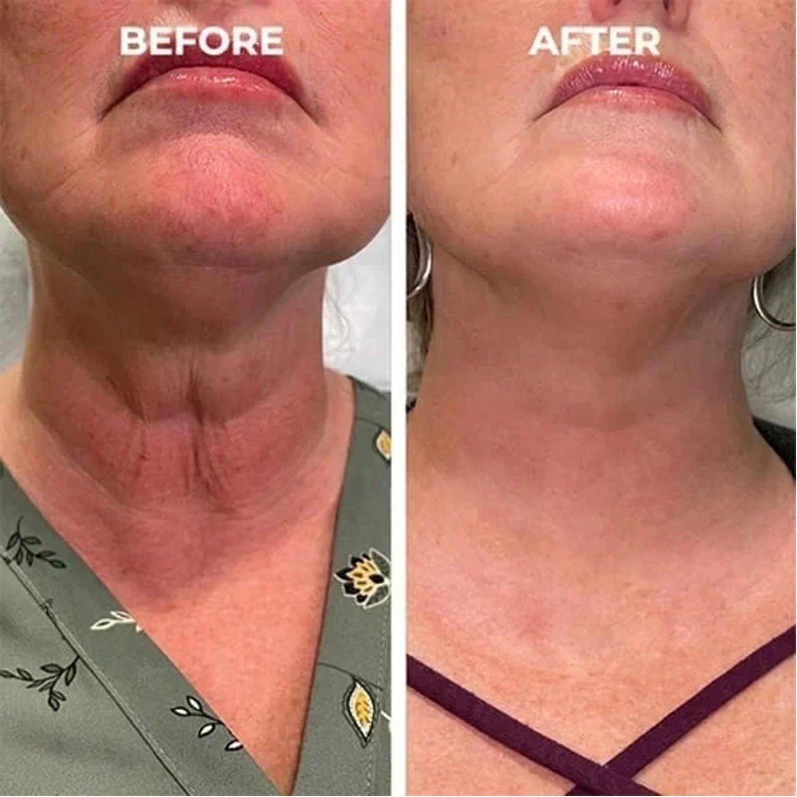 Facial Essence, Lifts And Tightens Facial Skin And Reduces Fine Lines And Wrinkles