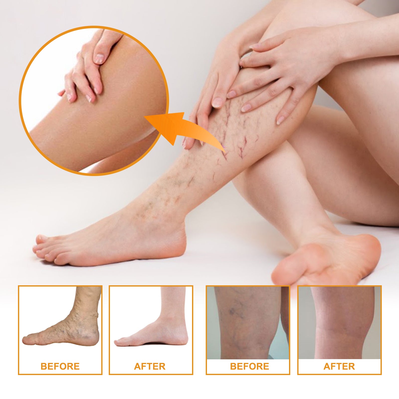 Vitamin K Varicose Vein Leg Cream