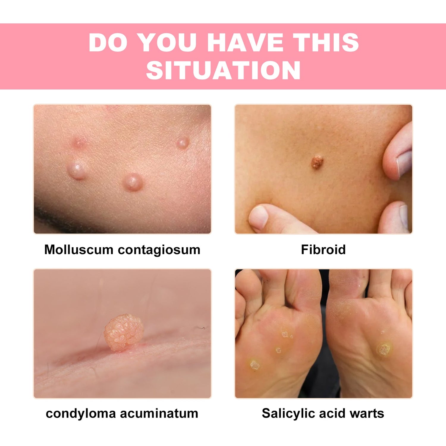 Skin Wart Lotion, Cleanses Skin And Removes Flat Eye Wart Lotion Especially Hand Cocoon