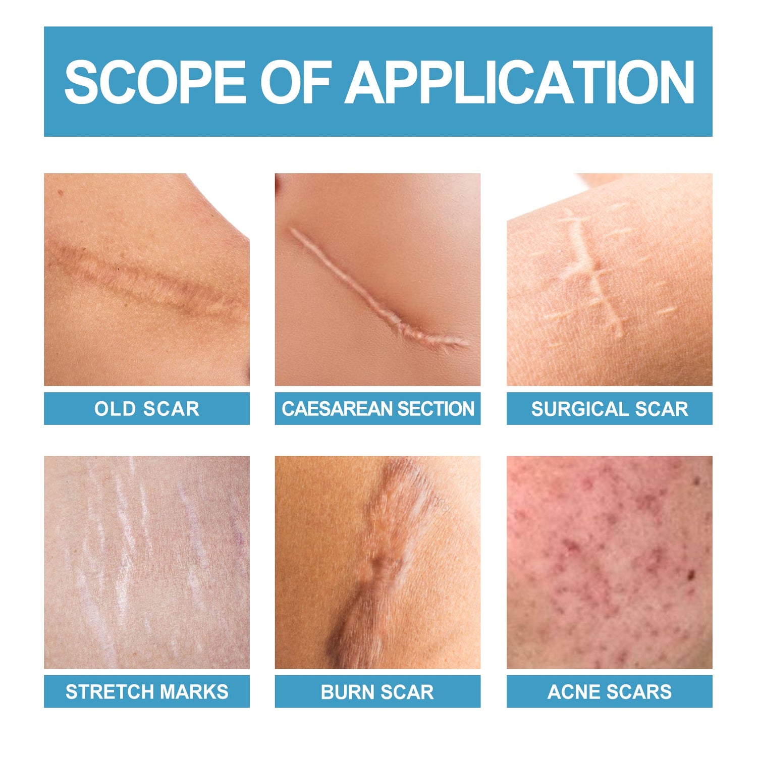 Scar Repair Serum Lightens Post-Pregnancy Scar Repair And Smoothes Body Skin